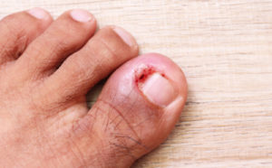 Ingrown Toenail Treatments