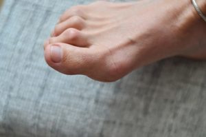 hammertoe treatment in fort collins, colorado