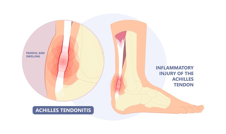 Achilles Tendon Rupture