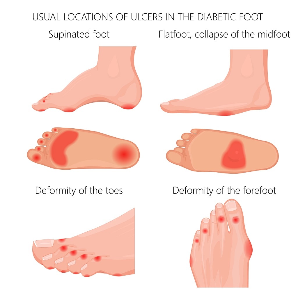 charcot foot diabetic foot