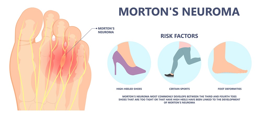 morton's neuroma