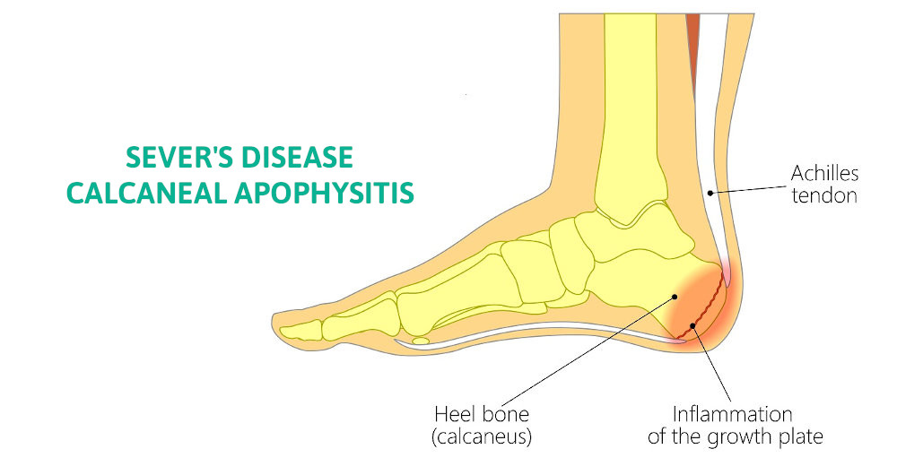 stretching sever's disease treatment