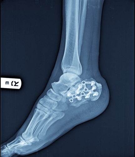ankle-fusion-surgery