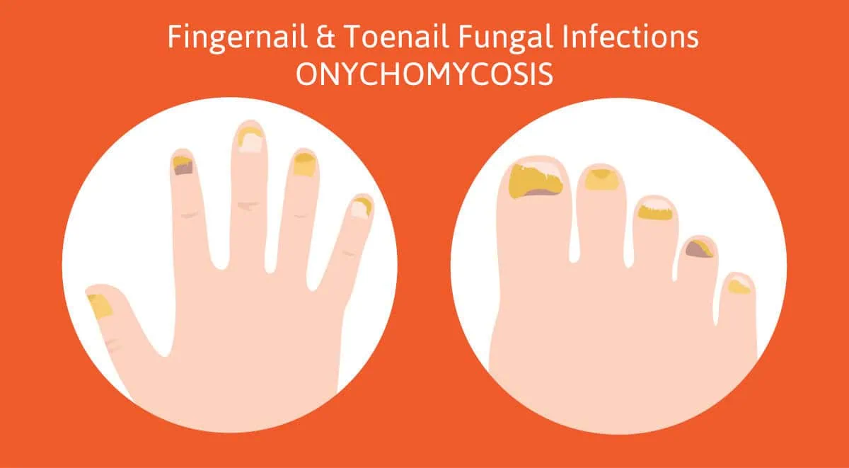 fingernail fungus laser treatment