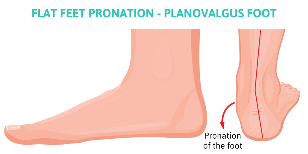 flat feet pronation