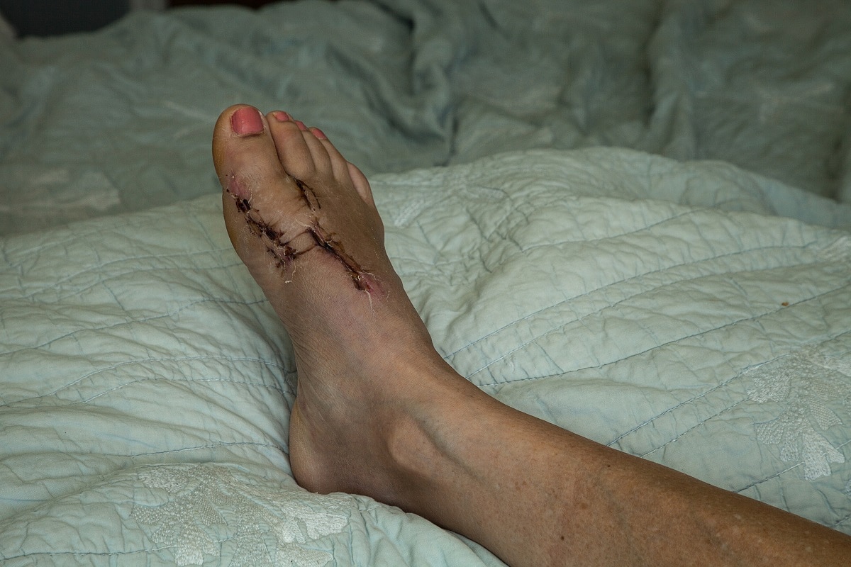 bunion Lapiplasty stitches