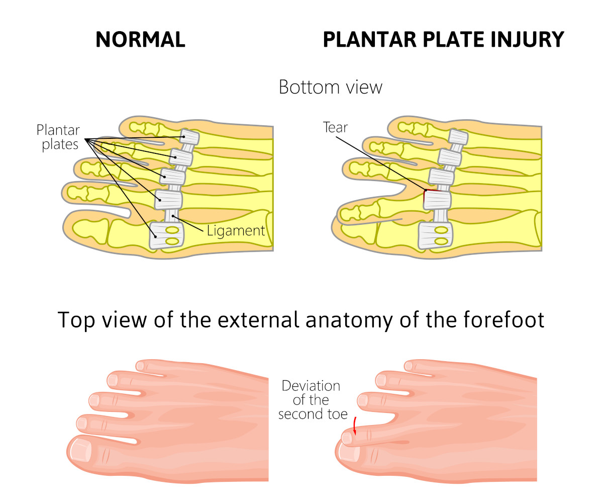 plantar plate tear