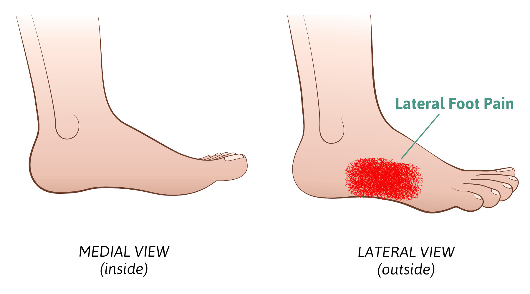 lateral foot pain
