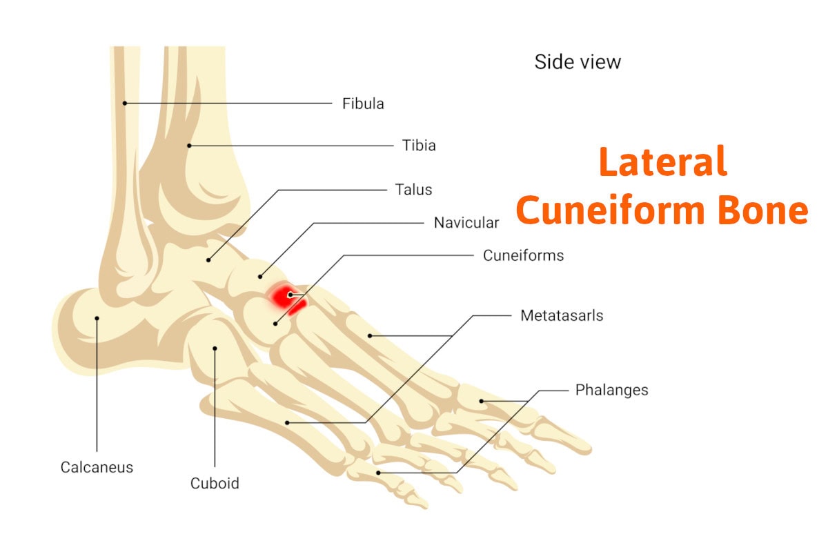 lateral cuneiform bone pain apc