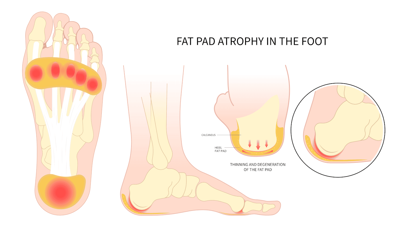 heel fat pad antrophy