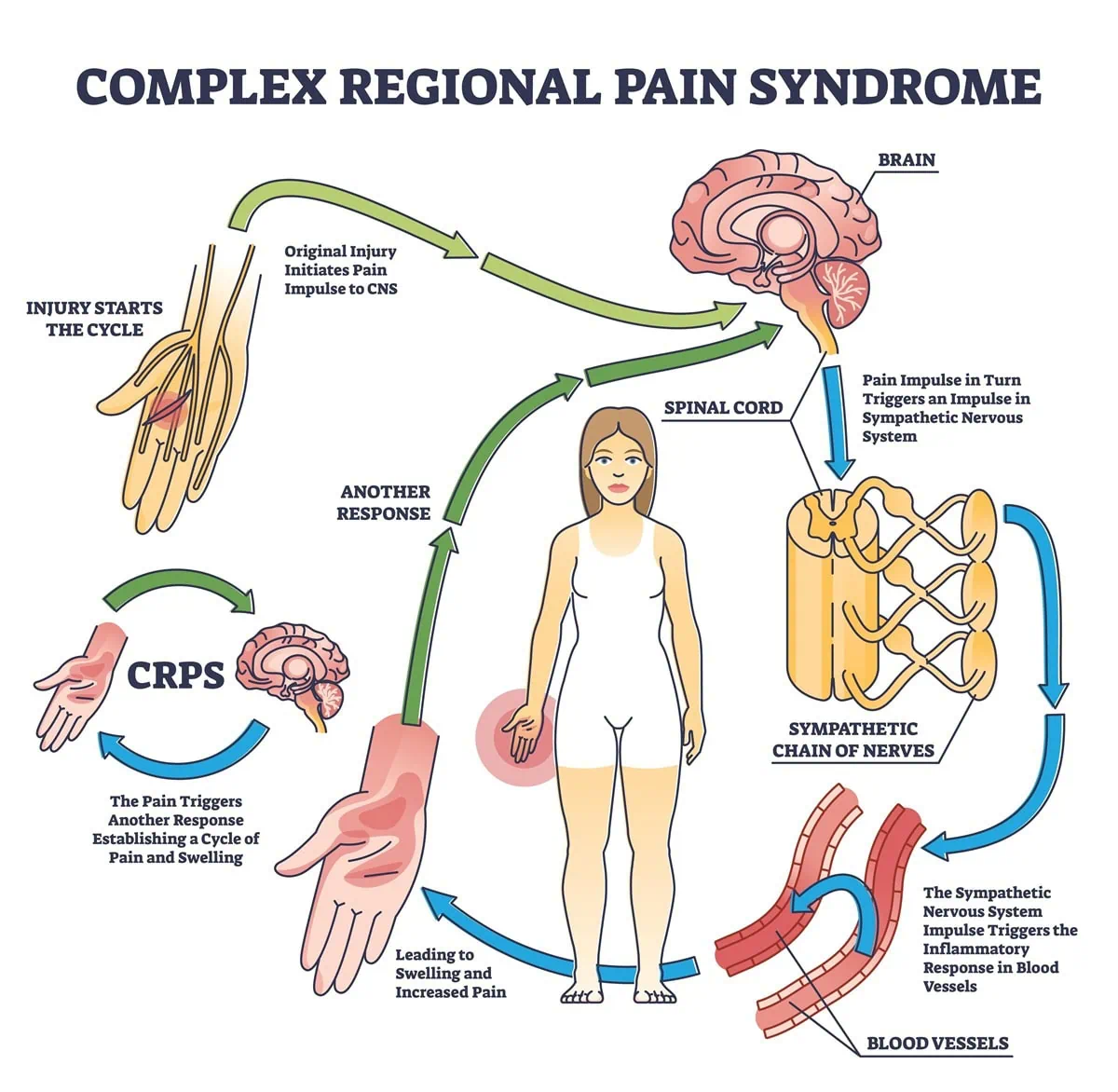 complex regional pain syndrome