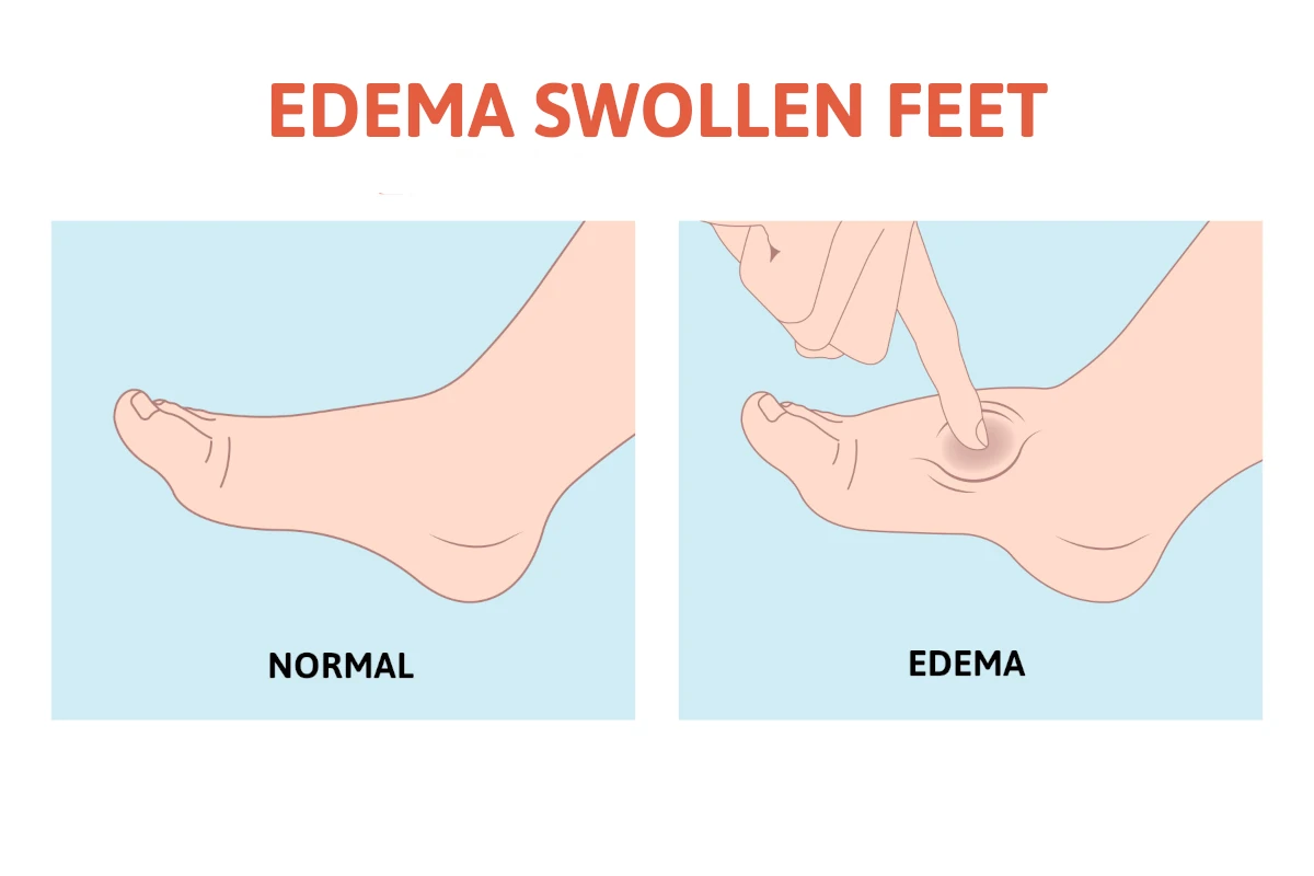 edema swollen feet