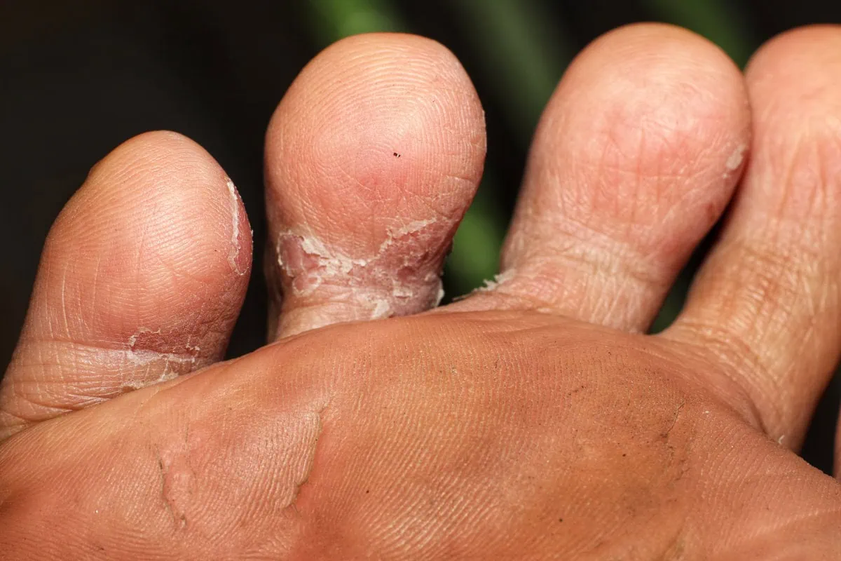 Tinea Pedis Athletes Foot