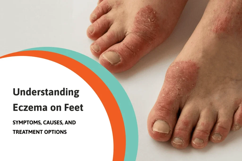 eczema on feet